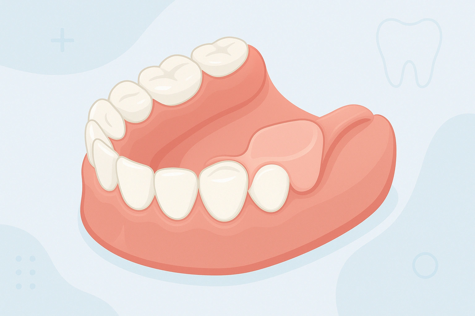 Illustration d’une prothèse dentaire partielle amovible sans crochet, intégrée naturellement aux gencives et dents.