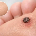 Gros plan d’une verrue sombre en guérison sur la peau, avec une zone saine en comparaison claire.